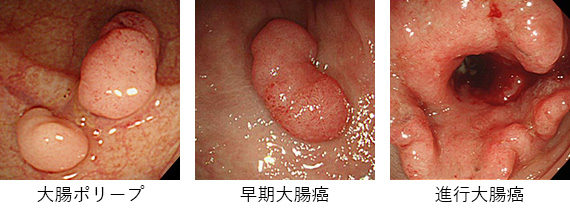 大腸癌